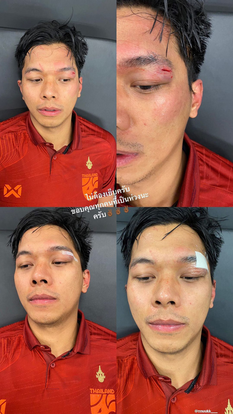Trung vệ Thái Lan rách mắt ở trận thua Malaysia - Ảnh 2