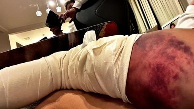 Takeru Segawa nhập viện với chân trái bầm tím trong ngày ra mắt ONE Championship - Ảnh 1