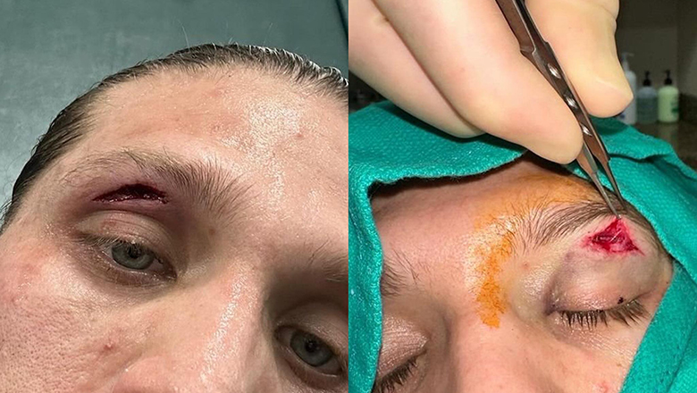 HLV Rener Gracie tiết lộ hình ảnh chấn thương mắt của Brian Ortega - Ảnh 2