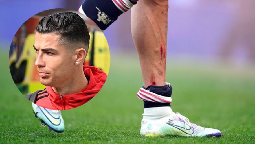 Ronaldo rách chân ở trận MU thua Everton