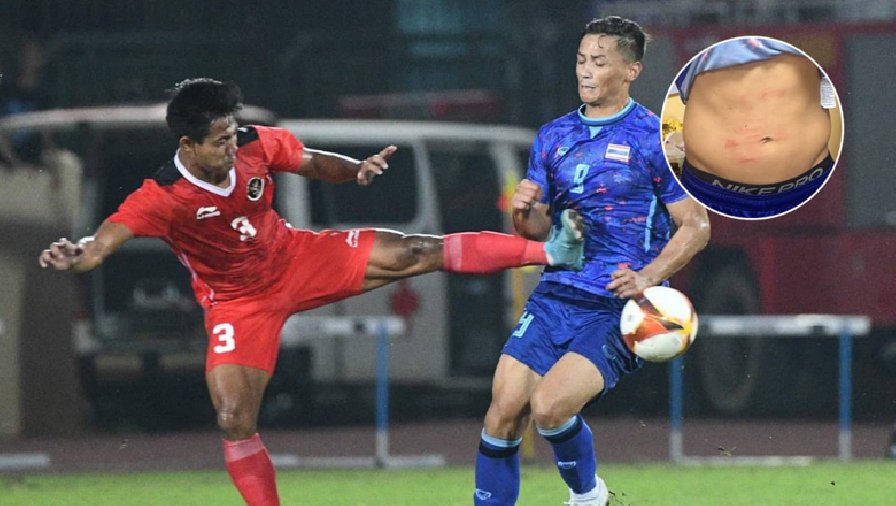 Tiền đạo gốc Thụy Điển của U23 Thái Lan ‘khoe’ vết thương sau chiến thắng Indonesia