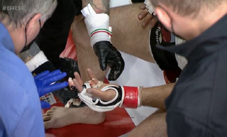 Võ sĩ MMA đứt lìa ngón tay khi thi đấu - Ảnh 2