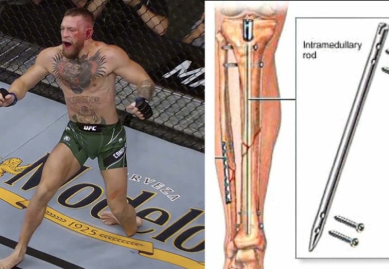 Bác sĩ y học thể thao nói về chấn thương, cơ hội hồi phục và tương lai của Conor McGregor trong MMA - Ảnh 2