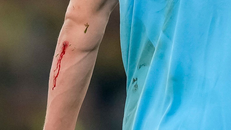 Haaland đổ máu trong ngày về lại Dortmund, bị thay ra ngay sau hiệp 1 - Ảnh 1